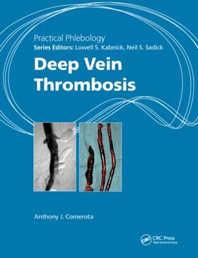 Deep Vein Thrombosis