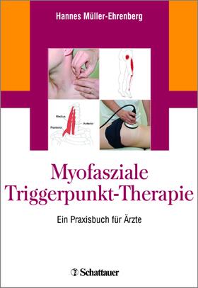 Myofasziale Triggerpunkt-Therapie