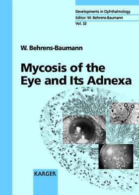 Mycosis of the Eye and Its Adnexa