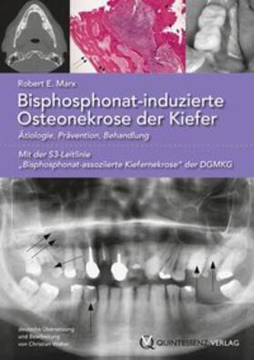 Bisphosphonat-induzierte Osteonekrose der Kiefer