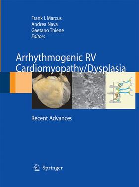 Arrhythmogenic RV Cardiomyopathy/Dysplasia