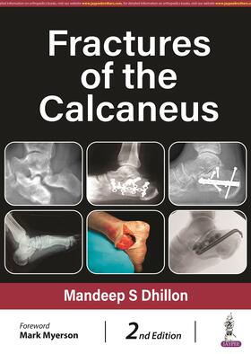 Dhillon, M: Fractures of the Calcaneus