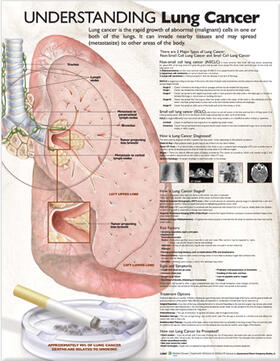 Understanding Lung Cancer Anatomical Chart