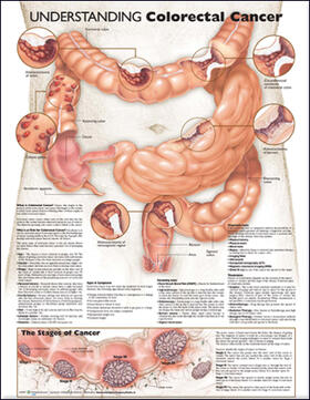 Understanding Colorectal Cancer Anatomical Chart